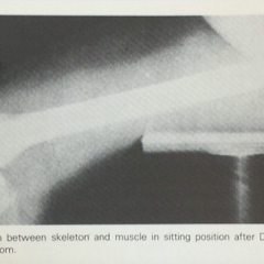 xray in newspaper article